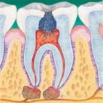Crie na Polpa Dentria ("Nervo")