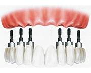 Substituição total com dentes cerâmicos Substituição total com dentes cerâmicos