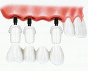 Colocação de dentes parciais em falta Colocação de dentes parciais em falta